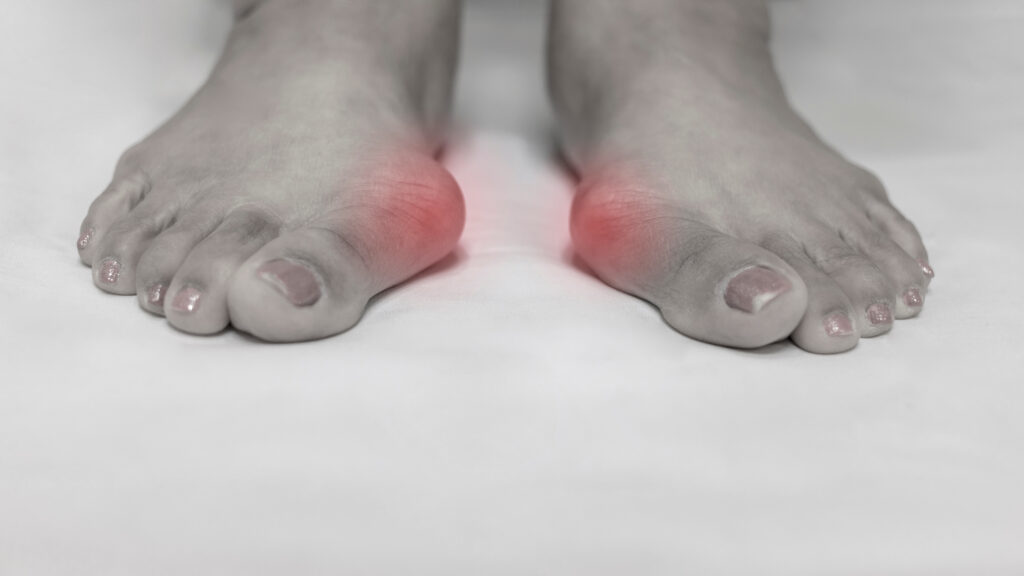 Tratamento Do Corset Ortopédico Dos Pés Hallux Valgus Foto de Stock -  Imagem de pés, deformidade: 174947028