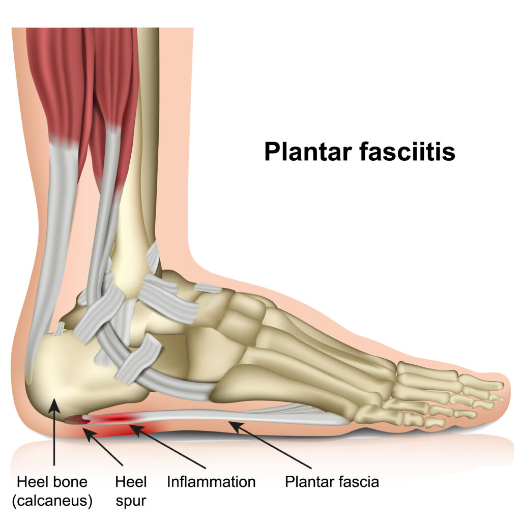 Fascite plantar