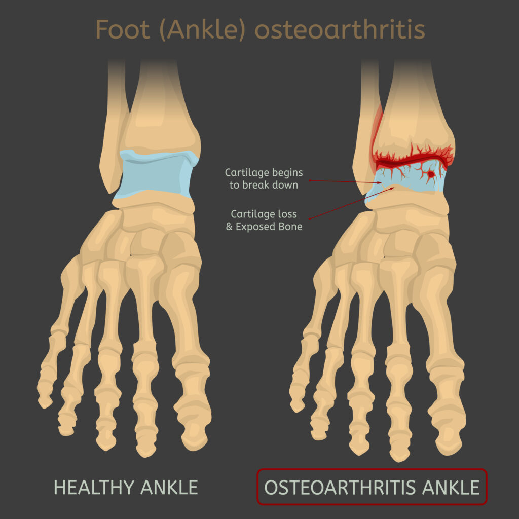 Artrose do tornozelo