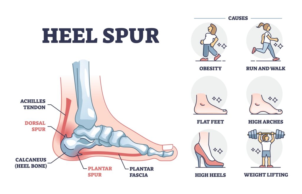 Causas fasciite plantar