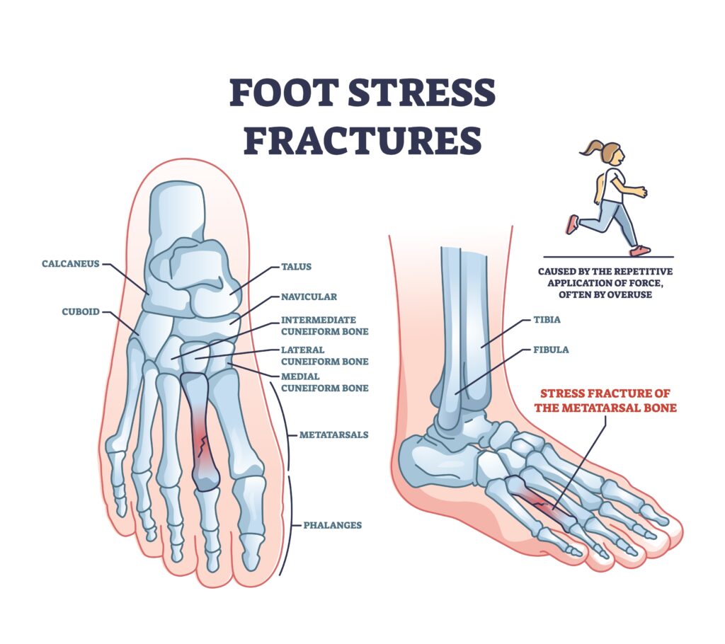 Fratura por estresse do pé
